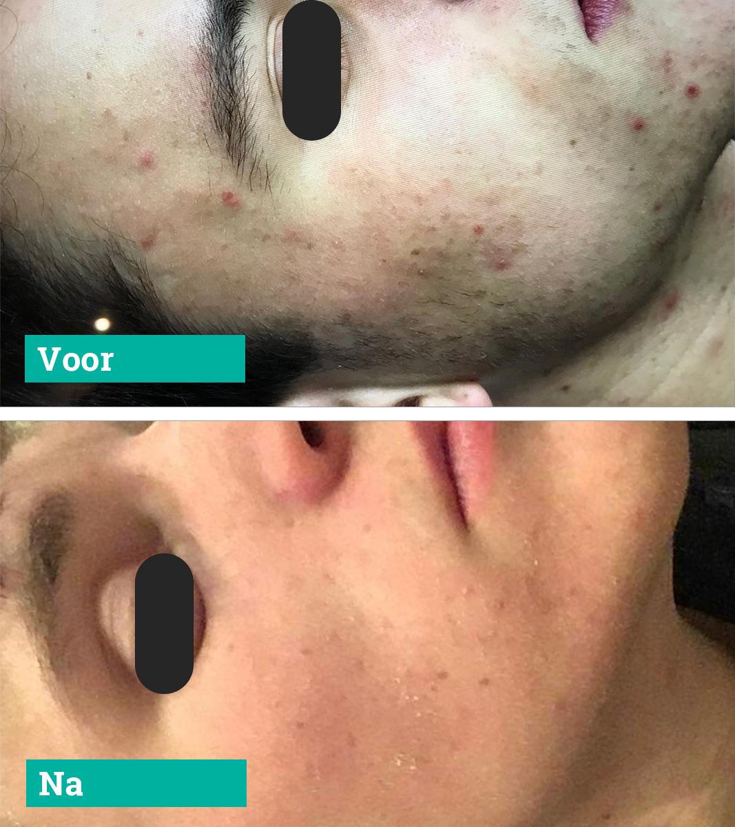 PCA SKIN acné behandeling Mi Sento: voor en na